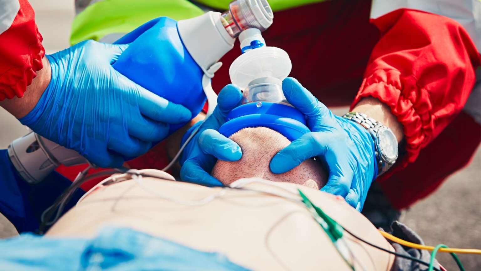 Rib Fractures During CPR: Causes, Complications, and Mitigation